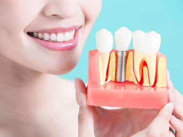 dental implant in rohini