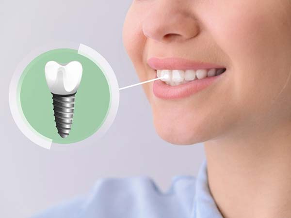 Full mouth dental implant in Pitampura