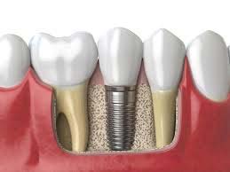 dental implants in rohini