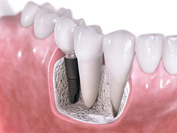 best dental implant in rohini