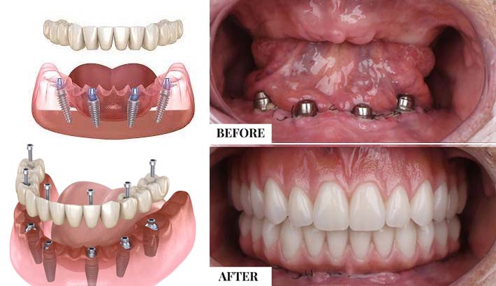 dental implant in rohini