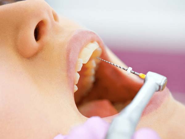 root canal treatment in Rohini