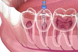 root canal treatment in Rohini